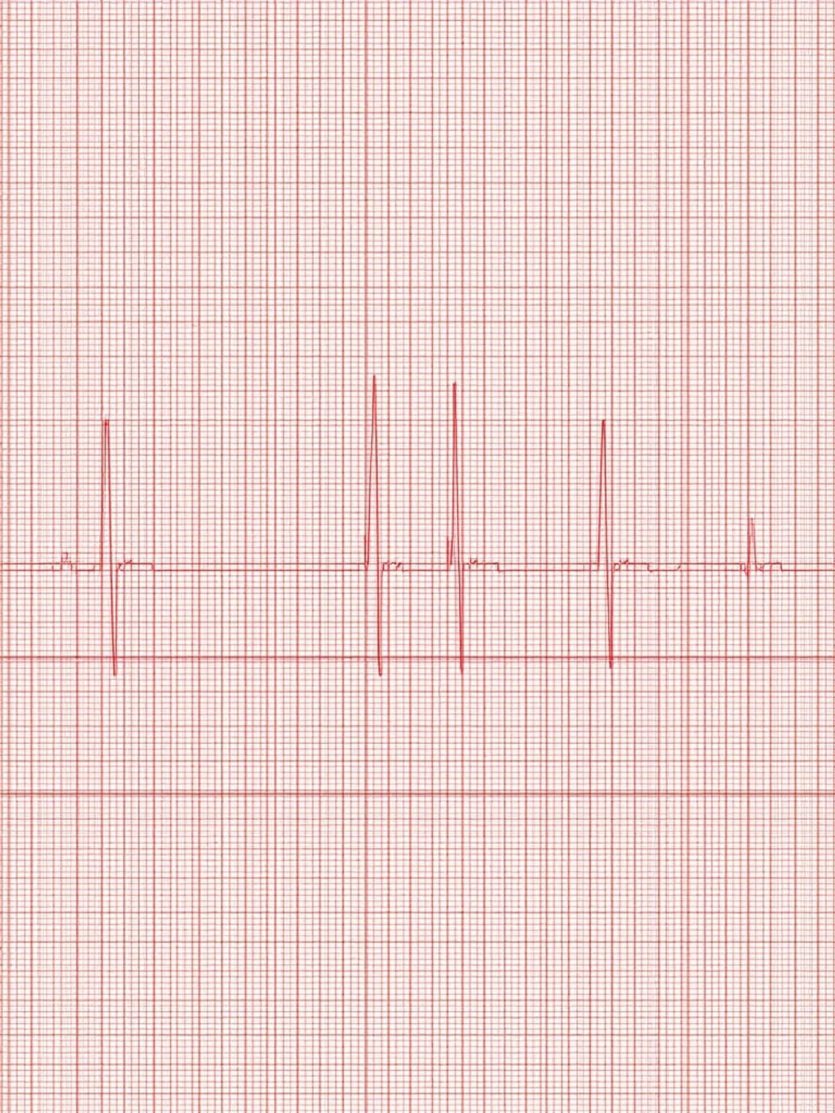 ECG anomalies - Interprétation de l'ECG : anomalies fréquentes