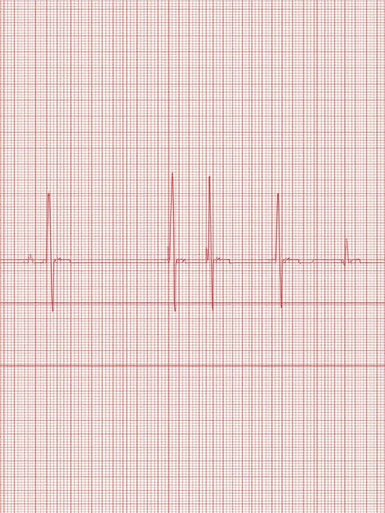 ECG anomalies - Interprétation de l'ECG : anomalies fréquentes